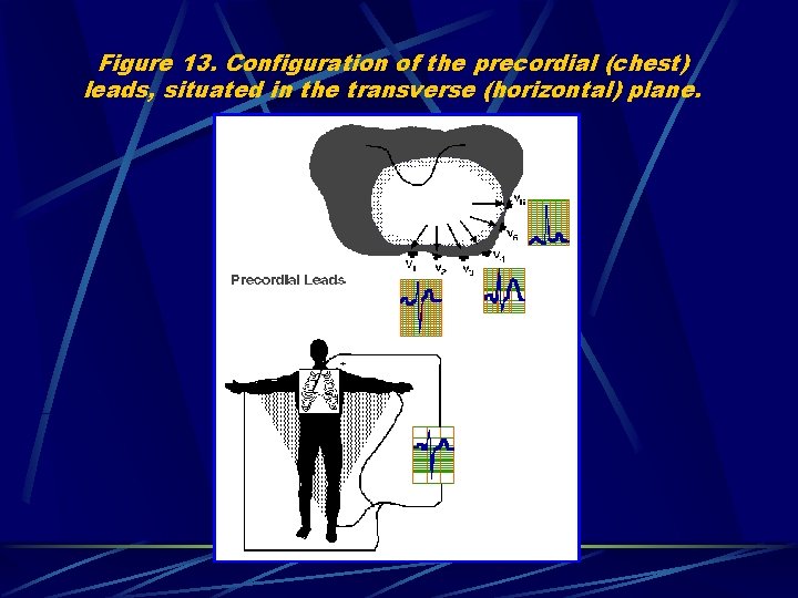 Figure 13. Configuration of the precordial (chest) leads, situated in the transverse (horizontal) plane.