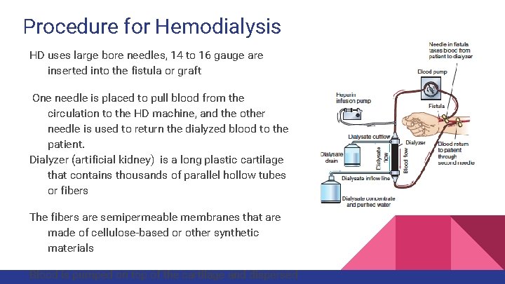 Procedure for Hemodialysis HD uses large bore needles, 14 to 16 gauge are inserted