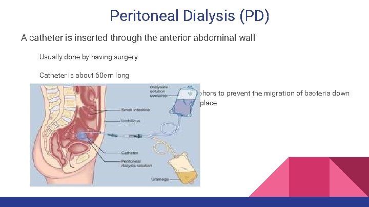 Peritoneal Dialysis (PD) A catheter is inserted through the anterior abdominal wall Usually done