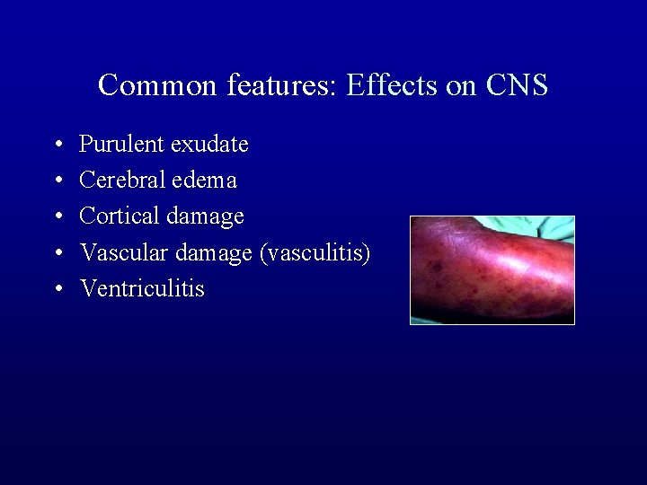 Common features: Effects on CNS • • • Purulent exudate Cerebral edema Cortical damage