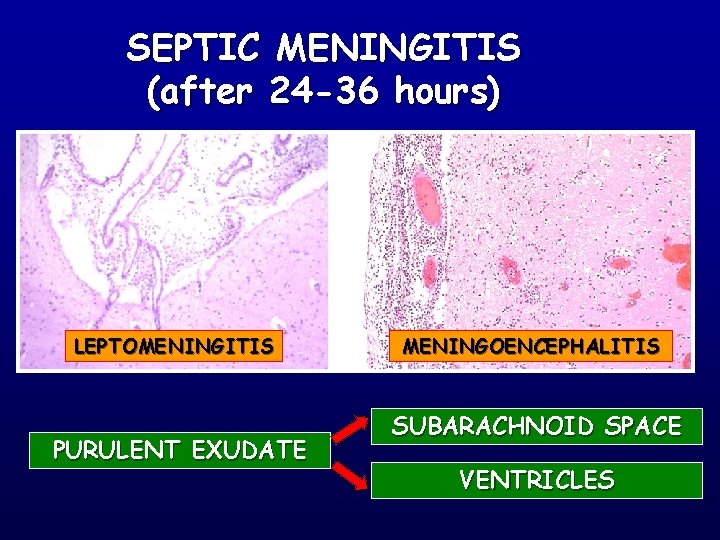 SEPTIC MENINGITIS (after 24 -36 hours) LEPTOMENINGITIS PURULENT EXUDATE MENINGOENCEPHALITIS SUBARACHNOID SPACE VENTRICLES 