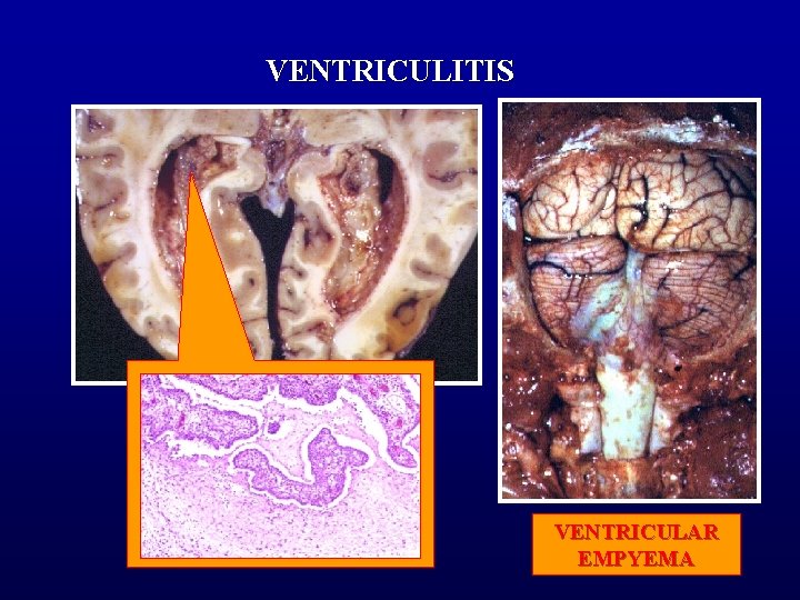 VENTRICULITIS VENTRICULAR EMPYEMA 