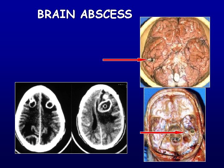 BRAIN ABSCESS 