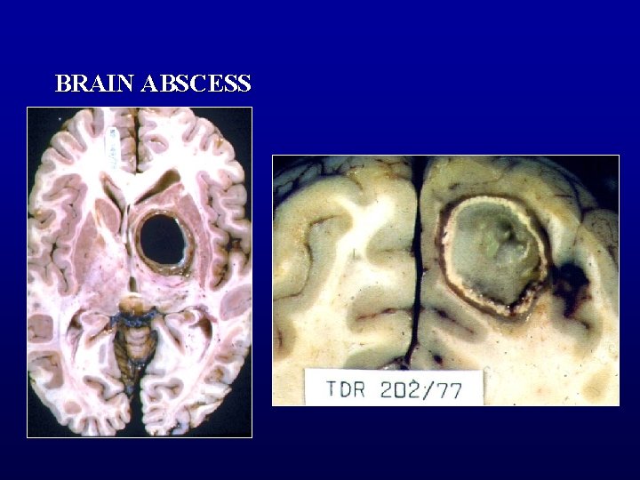 BRAIN ABSCESS 