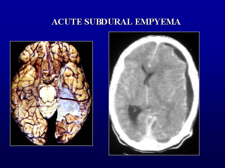 ACUTE SUBDURAL EMPYEMA 