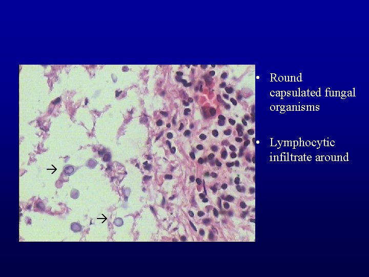  • Round capsulated fungal organisms • Lymphocytic infiltrate around 