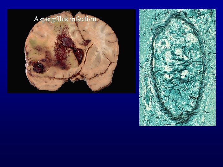 Aspergillus infection 