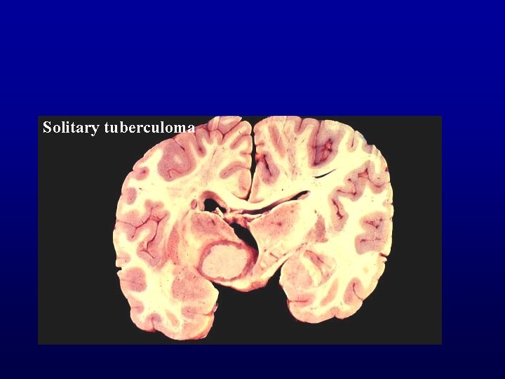 Solitary tuberculoma 