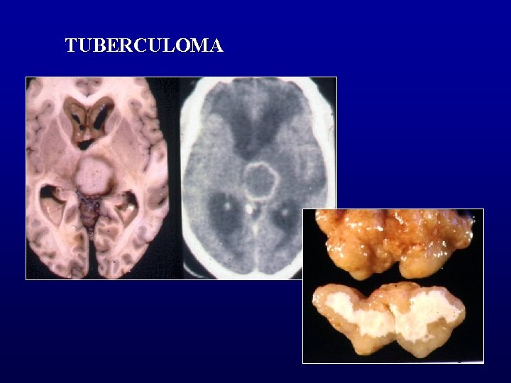 TUBERCULOMA 