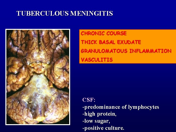 TUBERCULOUS MENINGITIS CHRONIC COURSE THICK BASAL EXUDATE GRANULOMATOUS INFLAMMATION VASCULITIS CSF: -predominance of lymphocytes