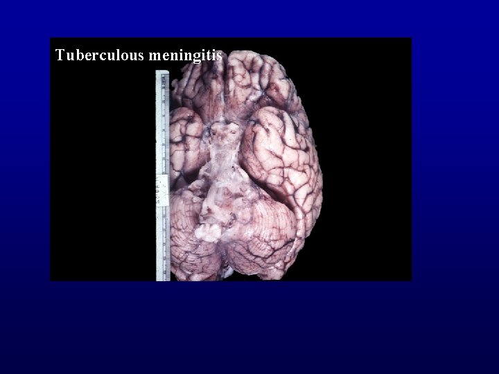 Tuberculous meningitis 