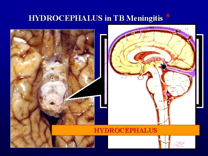 HYDROCEPHALUS in TB Meningitis * EXUDATE FILLING (BLOCKING) AMBIENT HYDROCEPHALUS CISTERN 