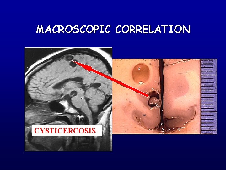 MACROSCOPIC CORRELATION CYSTICERCOSIS 