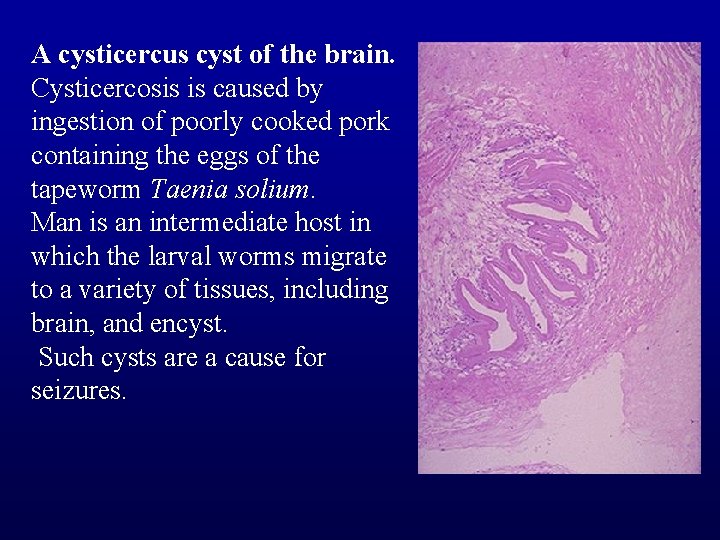 A cysticercus cyst of the brain. Cysticercosis is caused by ingestion of poorly cooked