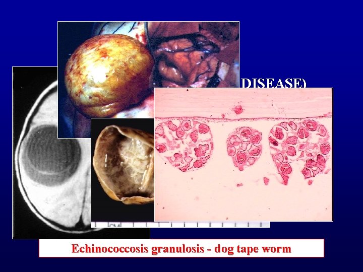  • ECHINOCOCCOSIS (HYDATID DISEASE) Echinococcosis granulosis - dog tape worm 