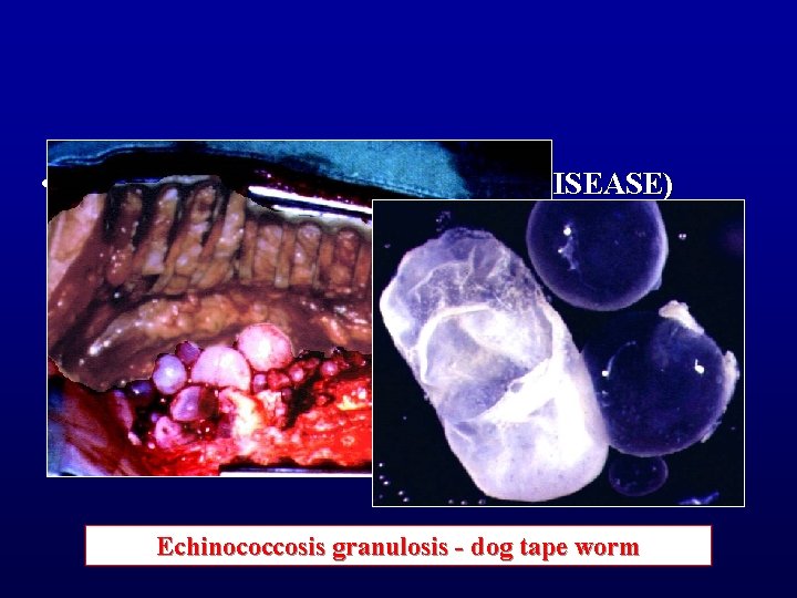  • ECHINOCOCCOSIS (HYDATID DISEASE) Echinococcosis granulosis - dog tape worm 