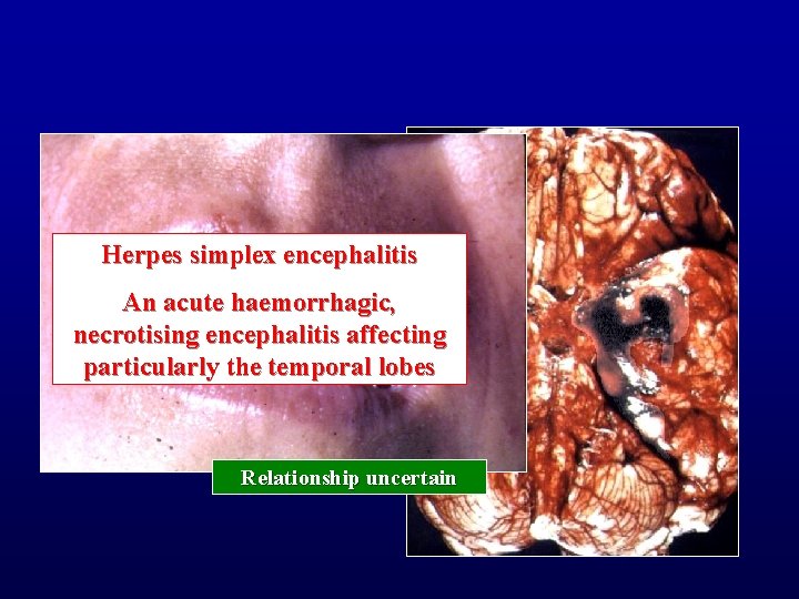 Herpes simplex encephalitis An acute haemorrhagic, necrotising encephalitis affecting particularly the temporal lobes Relationship