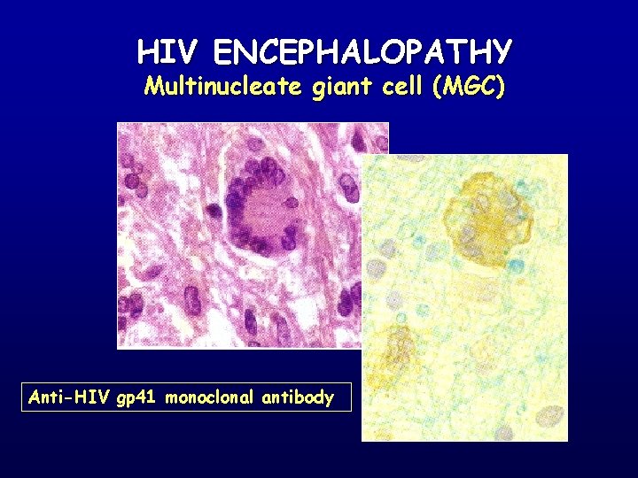 HIV ENCEPHALOPATHY Multinucleate giant cell (MGC) Anti-HIV gp 41 monoclonal antibody 