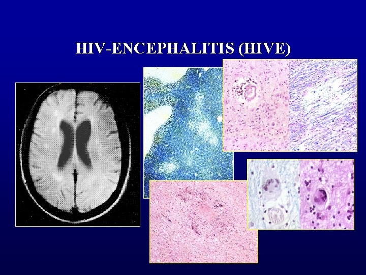 HIV-ENCEPHALITIS (HIVE) 