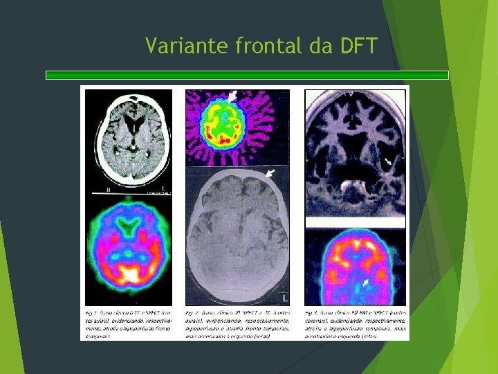 Variante frontal da DFT 