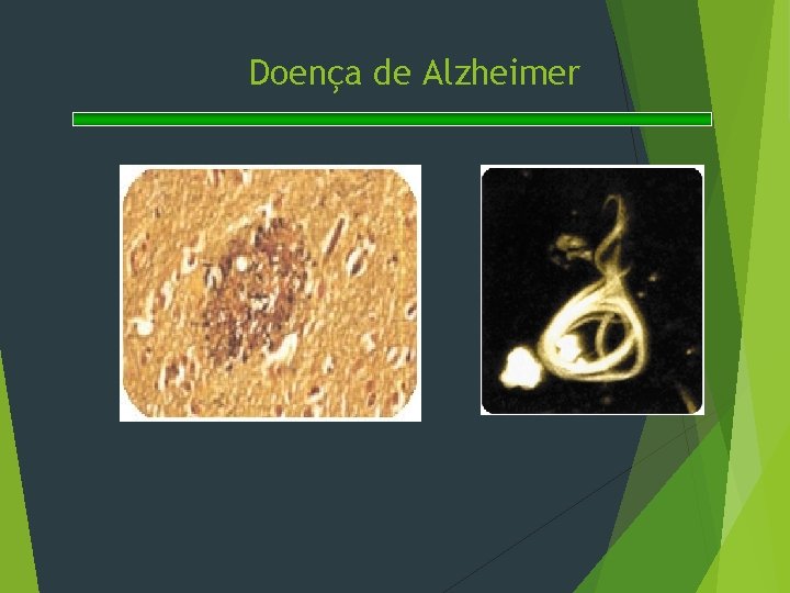 Doença de Alzheimer 