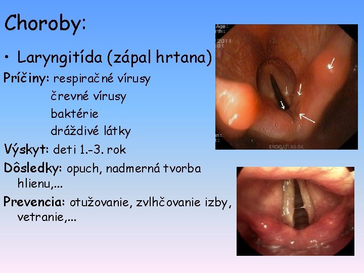 Choroby: • Laryngitída (zápal hrtana) Príčiny: respiračné vírusy črevné vírusy baktérie dráždivé látky Výskyt: