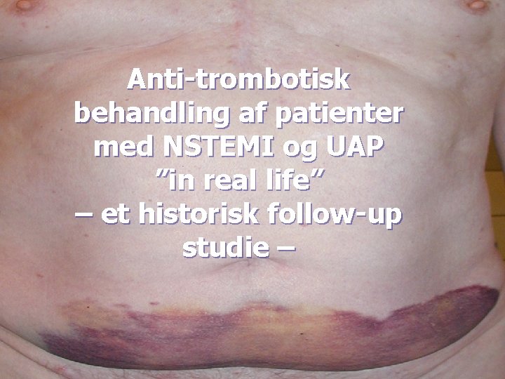 Anti-trombotisk behandling af patienter med NSTEMI og UAP ”in real life” – et historisk