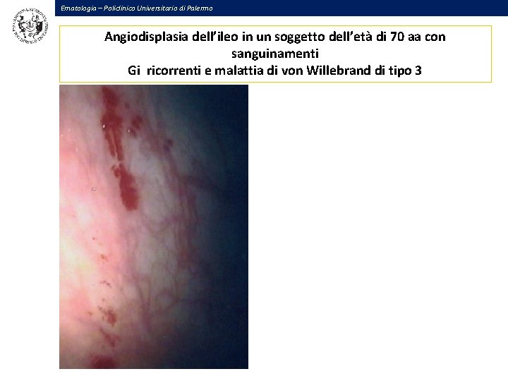 Ematologia – Policlinico Universitario di Palermo Angiodisplasia dell’ileo in un soggetto dell’età di 70