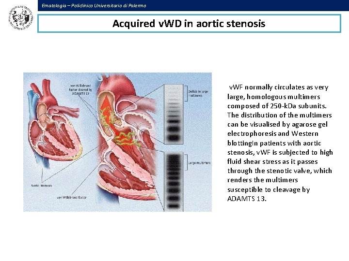 Ematologia – Policlinico Universitario di Palermo Acquired v. WD in aortic stenosis v. WF
