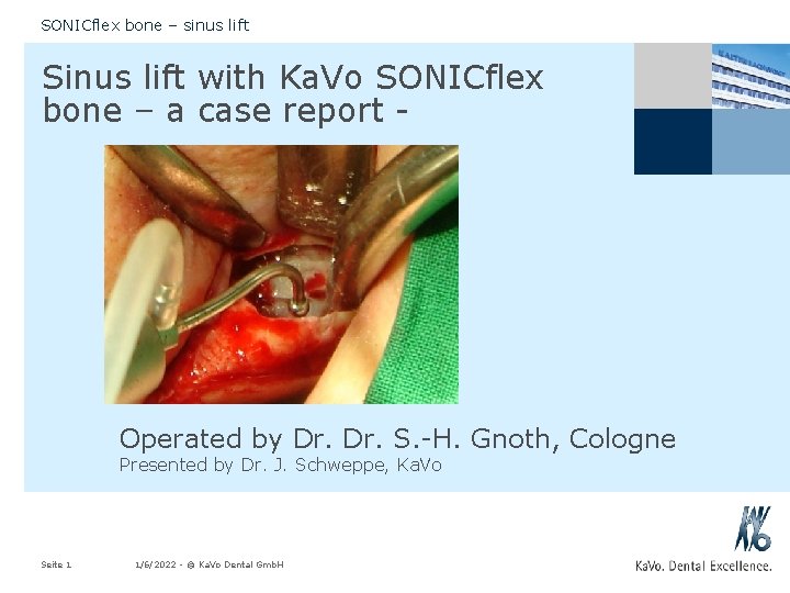 SONICflex bone – sinus lift Sinus lift with Ka. Vo SONICflex bone – a