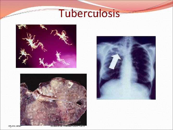 Tuberculosis 05. 02. 2012 Hepsibah RN; RM; MSN School of Nursin-Uo. N-CPN 