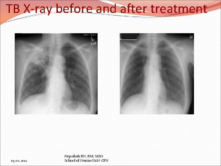 TB X-ray before and after treatment 05. 02. 2012 Hepsibah RN; RM; MSN School