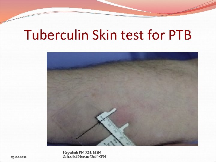 Tuberculin Skin test for PTB 05. 02. 2012 Hepsibah RN; RM; MSN School of