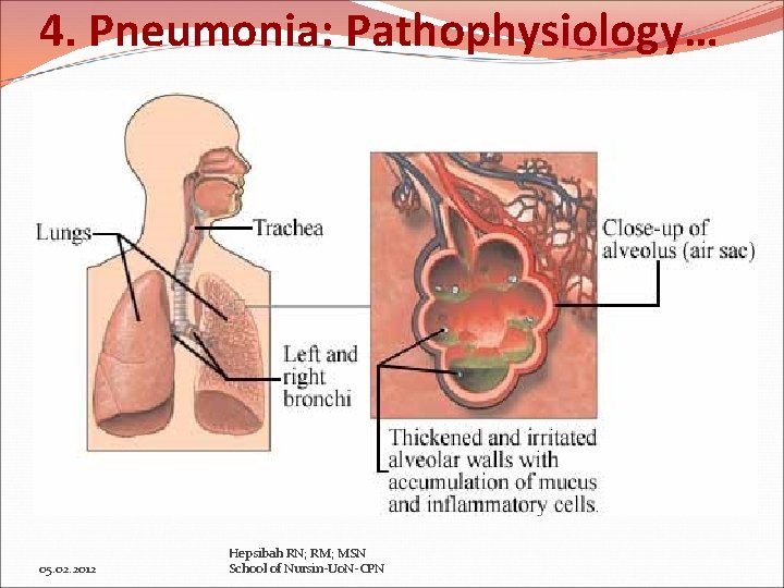 4. Pneumonia: Pathophysiology… 05. 02. 2012 Hepsibah RN; RM; MSN School of Nursin-Uo. N-CPN