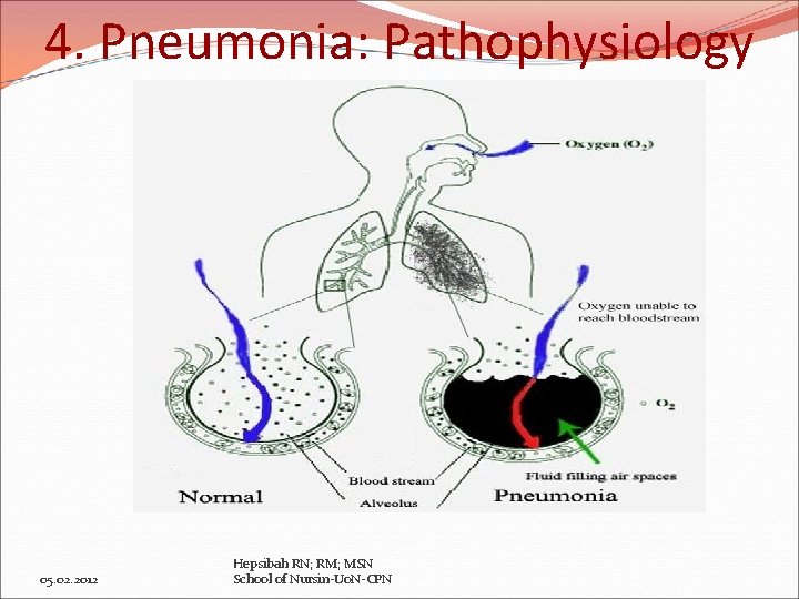 4. Pneumonia: Pathophysiology 05. 02. 2012 Hepsibah RN; RM; MSN School of Nursin-Uo. N-CPN