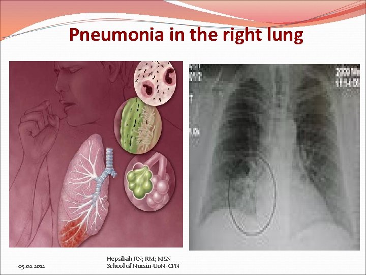 Pneumonia in the right lung 05. 02. 2012 Hepsibah RN; RM; MSN School of