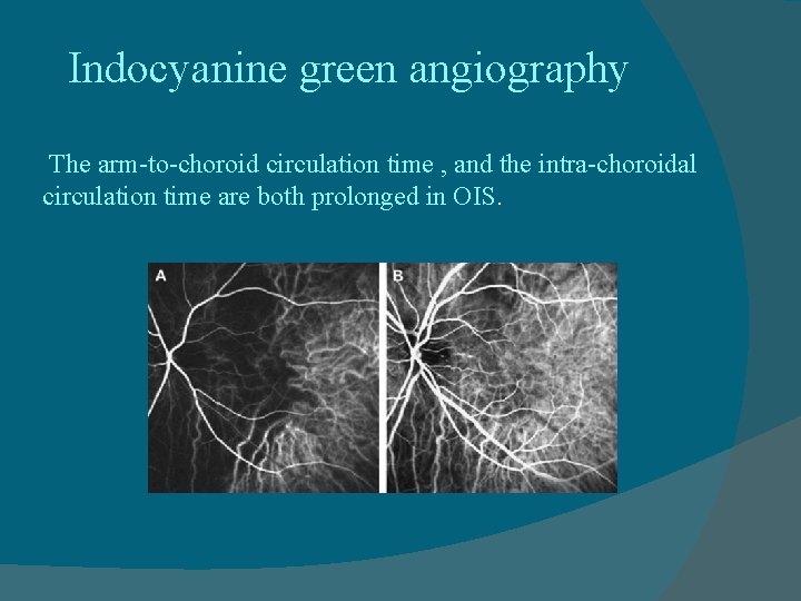 Indocyanine green angiography The arm-to-choroid circulation time , and the intra-choroidal circulation time are