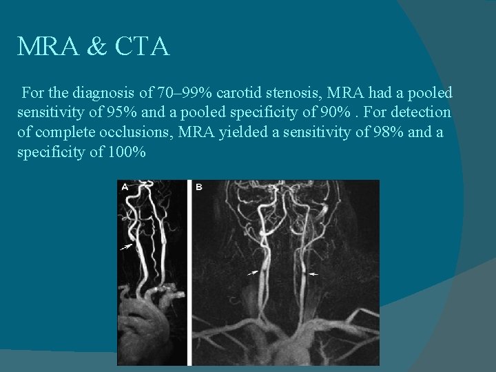 MRA & CTA For the diagnosis of 70– 99% carotid stenosis, MRA had a
