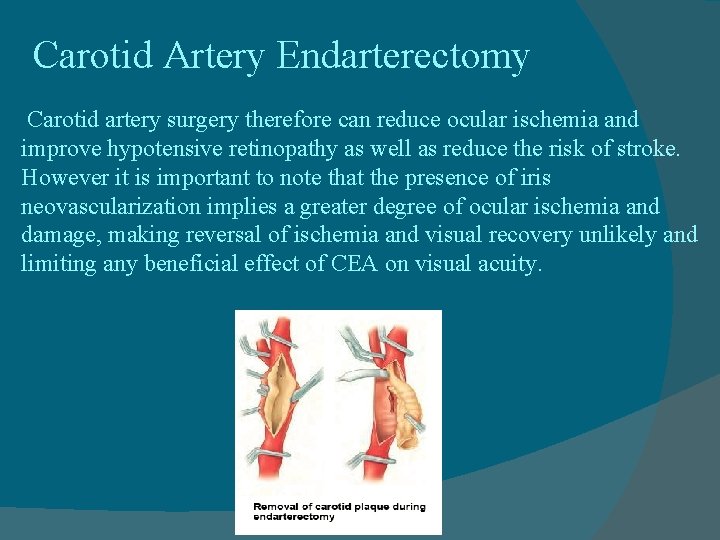 Carotid Artery Endarterectomy Carotid artery surgery therefore can reduce ocular ischemia and improve hypotensive