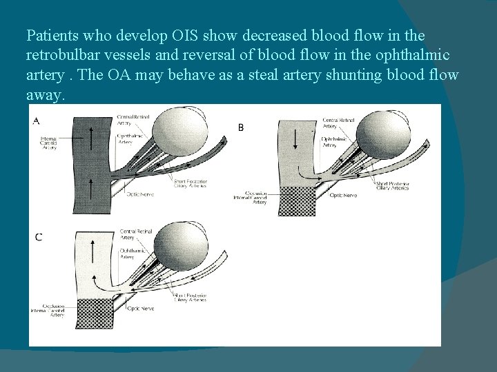 Patients who develop OIS show decreased blood flow in the retrobulbar vessels and reversal