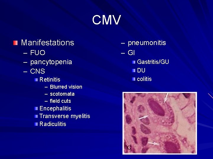 CMV Manifestations – FUO – pancytopenia – CNS Retinitis – Blurred vision – scotomata