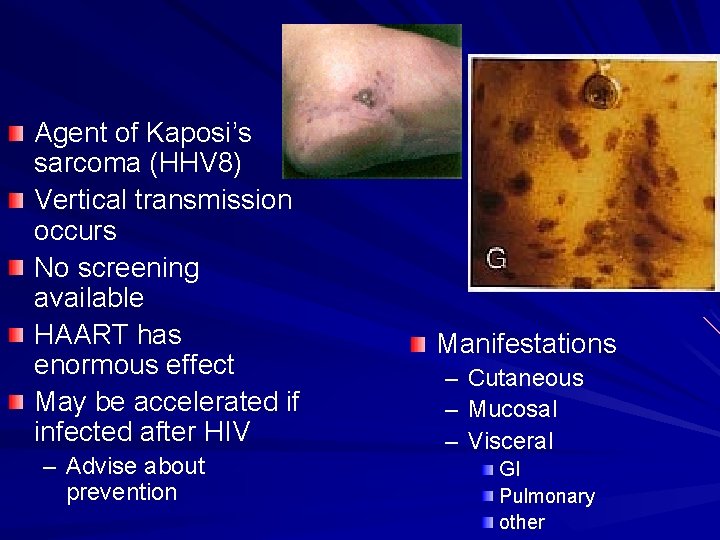 HHV-8 Agent of Kaposi’s sarcoma (HHV 8) Vertical transmission occurs No screening available HAART