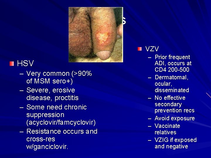 Herpes VZV HSV – Very common (>90% of MSM sero+) – Severe, erosive disease,