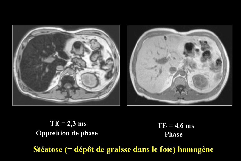 TE = 2, 3 ms Opposition de phase TE = 4, 6 ms Phase