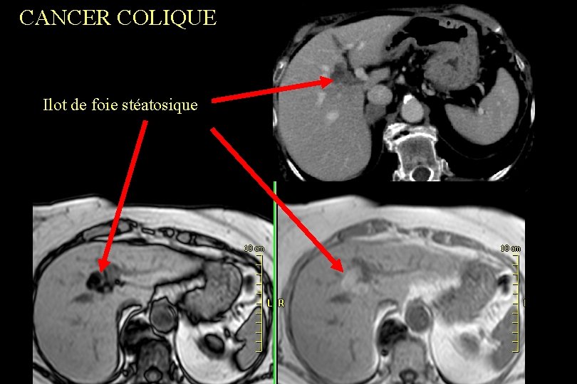 CANCER COLIQUE Ilot de foie stéatosique 