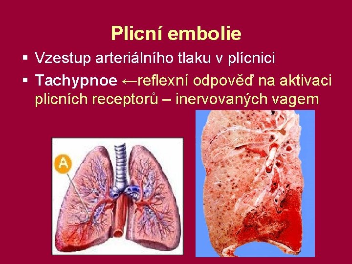 Plicní embolie § Vzestup arteriálního tlaku v plícnici § Tachypnoe ←reflexní odpověď na aktivaci