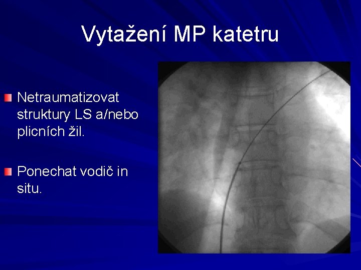 Vytažení MP katetru Netraumatizovat struktury LS a/nebo plicních žil. Ponechat vodič in situ. 