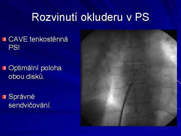 Rozvinutí okluderu v PS CAVE tenkostěnná PS! Optimální poloha obou disků. Správné sendvičování. 