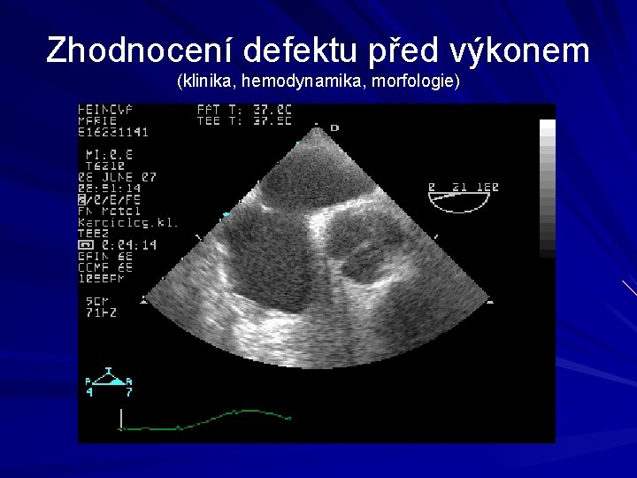 Zhodnocení defektu před výkonem (klinika, hemodynamika, morfologie) 