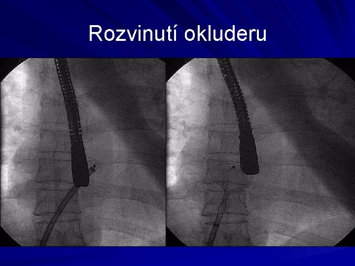 Rozvinutí okluderu 